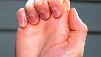 Hand Tendon Glide Exercise (Part 2) video thumbnail