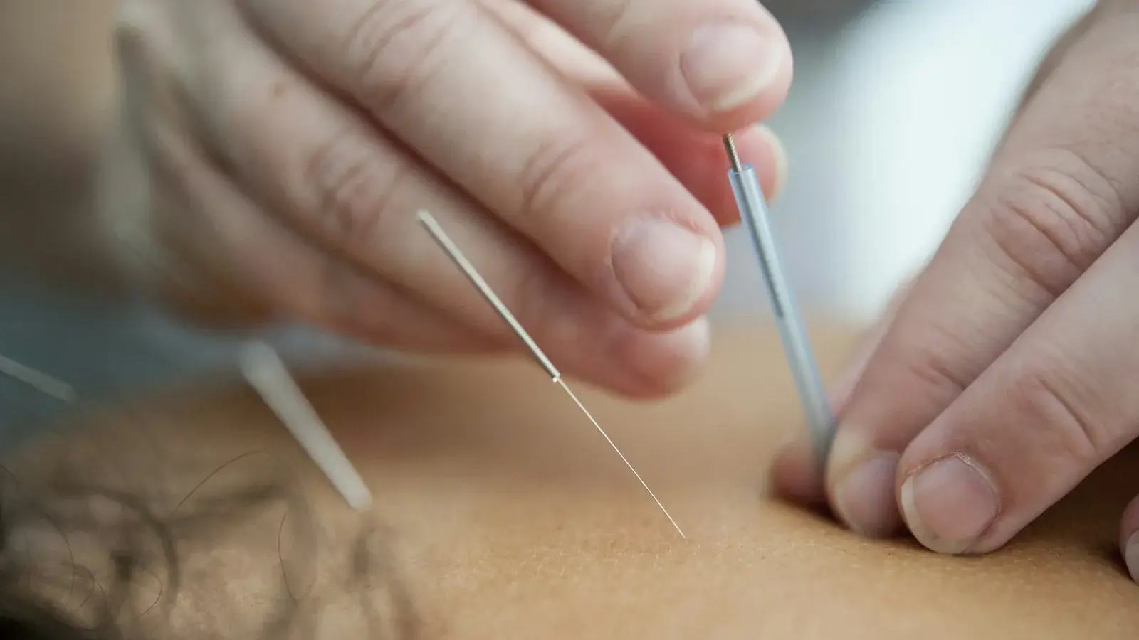 Practitioner placing fine needles into a patient's back muscles