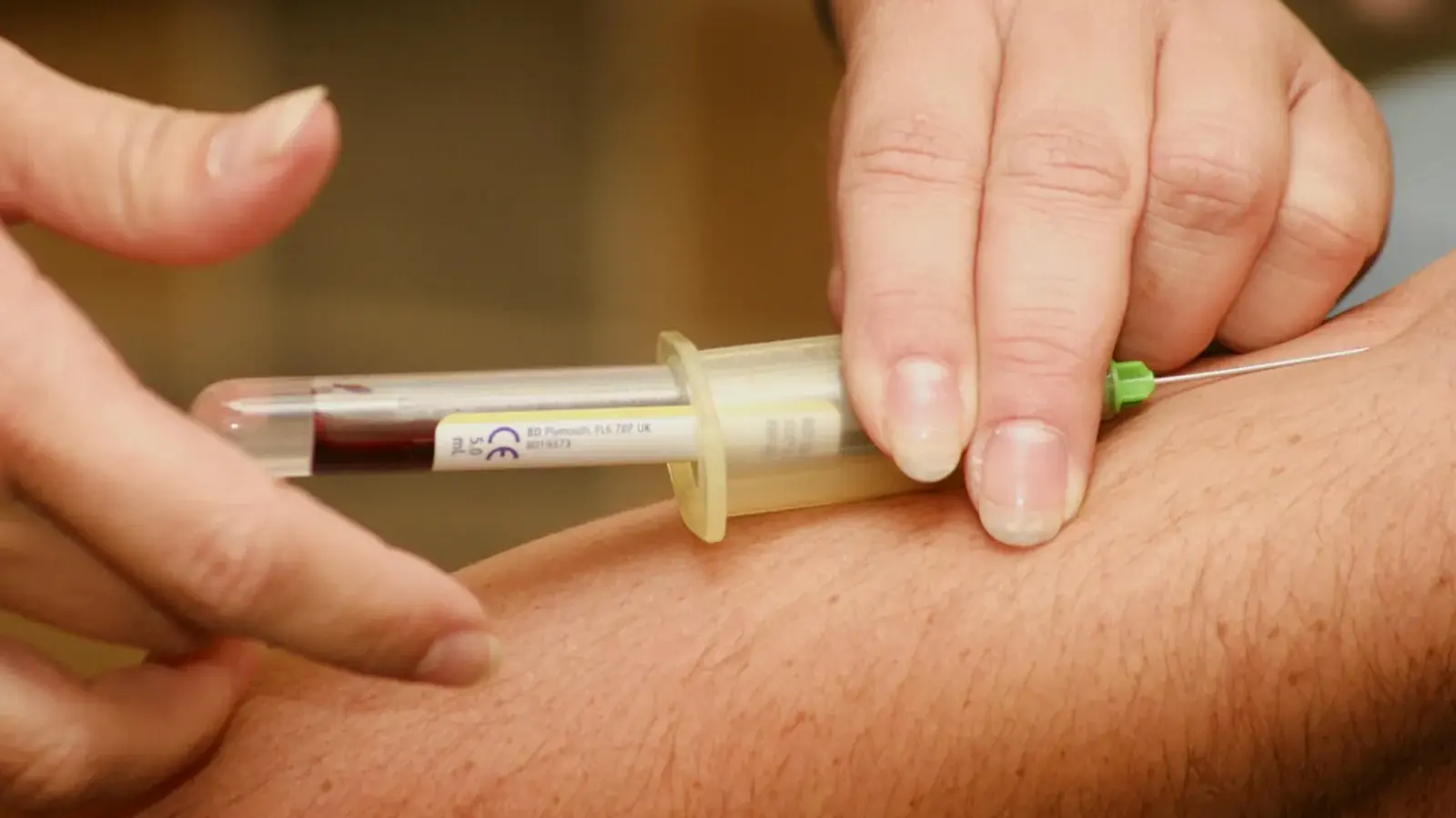 Blood sample being drawn into a syringe for platelet-rich plasma preparation