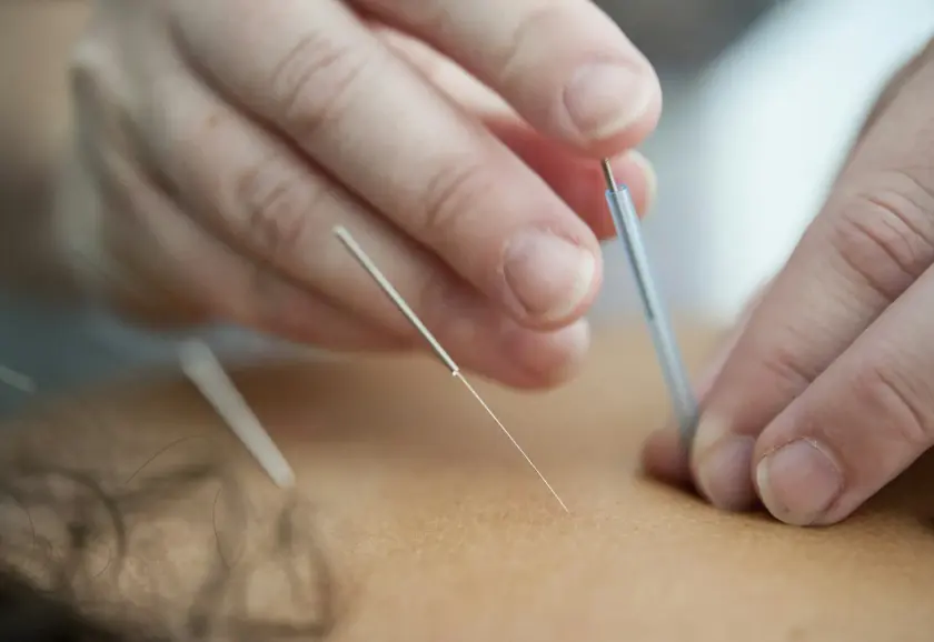 Practitioner placing fine needles into a patient's back muscles